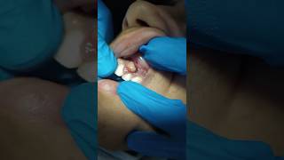 Periapical Abcess Fistula drainage dentist tooth shortsfeed shortviral shorttrending [upl. by Hplar]