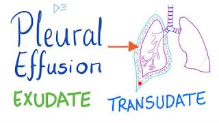 Exudate and transudate pleural effusion difference  mnemonic  MEDICINE with DR SHAMAMA [upl. by Aisital]