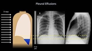 How to Interpret a Chest XRay Lesson 6  Diaphragm and Pleura [upl. by Giana]