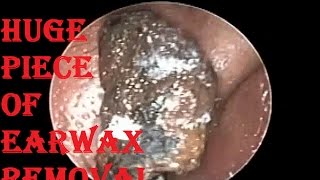 Endoscopic Giant Piece of Ear Wax Removal From Ear Canal By Microsuction [upl. by Buckie640]