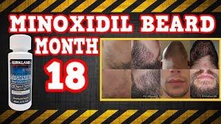 Minoxidil Beard Growth Results  Month 18 on Minox for the Beard  TheJourneyContinues [upl. by Aicelef]