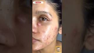 How to remove piplesAcne at home shorts acne pimple ytshorts [upl. by Akoyn]