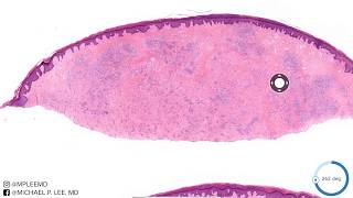 Erythema Elevatnum Diutnem Rare form of vasculitis Dermpath Made Easy [upl. by Kinimod]