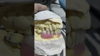 Lower Removable Partial Denture By Haider 😁😁😁removablepartialdenture [upl. by Fitalludba]