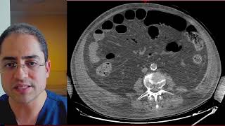Qual o passo a passo para dar diagnóstico de isquemia mesentérica na TC de Abdome [upl. by Tillie134]