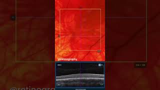 Foveal hypoplasia in ocular albinismretina oftalmo ophthalmology oftalmologia oftalmología [upl. by Stranger]