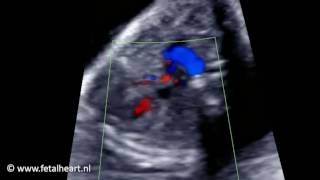 Fetal heart Academy  Tetralogy of Fallot 1 RVOT color Doppler [upl. by Bedad]