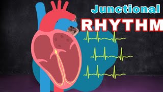 Heartrelated Problems  Junctional Rhythm shorts [upl. by Laubin]