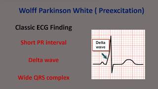 Basic WPW ECG Pattern [upl. by Pavlish]