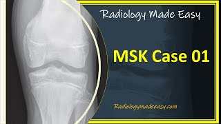 FRCR Radiology MSK Case 01  A 13 yrs old boy presented with pain in the left lower limb [upl. by Kerrison]