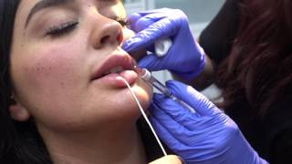 Keyhole Pout Lip Augmentation amp Cheek Augmentation with Restylane and Radiesse [upl. by Chao]