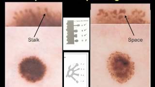 Melanoma specific criteria by Dr A Marghoob [upl. by Eahsed602]