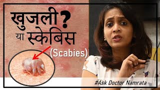 ये खुजली क्या स्केबिस  Scabies  है  क्यों हुआ  इलाज कैसे करे  AskDoctorNamrata [upl. by Eckmann]