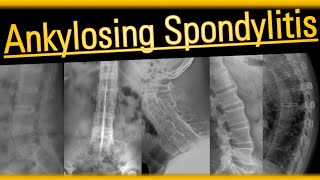 Ankylosing Spondylitis arthritis radiology bones [upl. by Carolynne214]