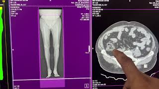 Ct angiography lower limb radiology on siemens 16 slice machine [upl. by Earl]