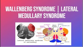 Wallenberg Syndrome  Lateral Medullary Syndrome  PhysiotherapyKnowledge [upl. by Marilou]