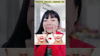 Remove Pockets of fat at corners of mouth Perioral Mounds [upl. by Burlie]