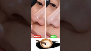 Best home remedy to remove Blackheads amp Whiteheads  How to get rid of pimple on your chin [upl. by Rramaj]