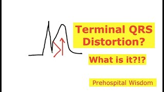 What the Hell is Terminal QRS Distortion [upl. by Hussein]