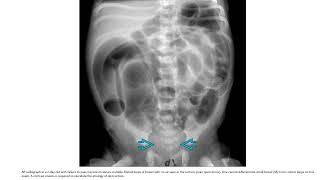 Hirschsprung Disease Imaging [upl. by Borgeson]