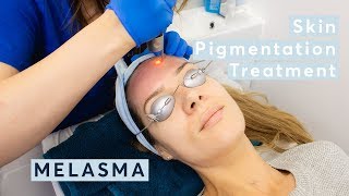 Melasma Skin Pigmentation Treatment using PicoSure Laser [upl. by Larochelle]