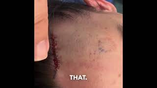 Osteoma or Lipoma Forehead Removal [upl. by Inanaup]