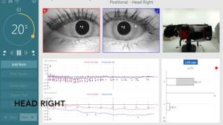 BPPV Assesment with the new TRV Chair by Interacoustics [upl. by Mctyre729]