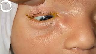 Congenital Lacrimal Encysted Mucocele [upl. by Wareing953]