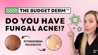 5 Signs You Have Fungal Acne…NOT Regular Acne  The Budget Derm Explains [upl. by Behl970]