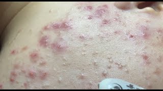 How to treat acne during pregnancy  No P4 HoangMySpa130 [upl. by Wobniar179]