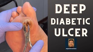 DEEP Diabetic Foot Ulcer podiatristfoot and ankle specialist treats a foot ulcer [upl. by Nonez]