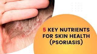 5 Key Nutrients for Skin Health Psoriasis [upl. by Sturges]