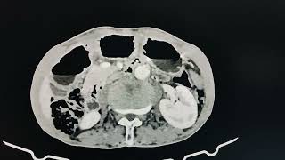 hepatic metastasis segment VI [upl. by Neyuh]