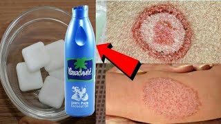 सिर्फ 2 दिन मे दाद खाज खुजली Fungal infectionको जड़ से खत्म करने का रामबाण उपायRingworm treatment [upl. by Adnalu]