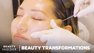 How Nonsurgical FaceLifts Work With PDO Threads  Beauty Transformations  Insider Beauty [upl. by Arannahs]