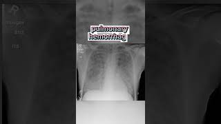 Whats diffuse alveolar hemorrhage [upl. by Osrock]