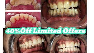 Scaling and Polishing Price in PakistanTooth whitening costBleaching procedureScalingProcedure [upl. by Lamdin]