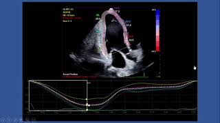 Strain Echocardiography by speckle tracking and tissue Doppler Part Itechnique [upl. by Zanas905]