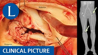 Antiphospholipid syndrome following Q fever [upl. by Vinni798]