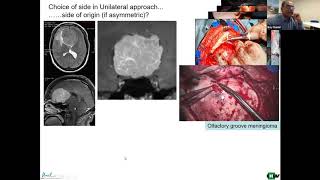 Tuberculum sellae meningiomas [upl. by Eiwoh]