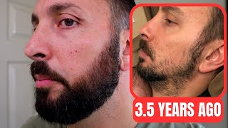 Minoxidil Beard Journey 35 Years Later  How To Grow A Real Beard [upl. by Euqinot]