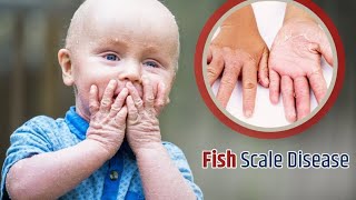 genetic disease ichthyosis vulgaris treatment videos fish scale disease treatment [upl. by Dewhurst983]