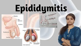 Epididymitis [upl. by Sherl]