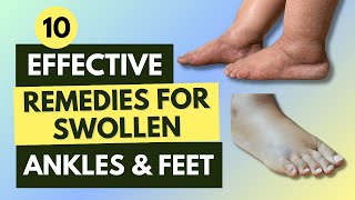 10 Effective Remedies For Swollen Ankles amp Feet [upl. by Eeliram]