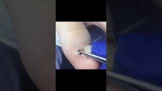 Ingrown toenail removal with Pedicure Knife Cut it easily Ep260 [upl. by Ailat123]