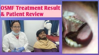 Oral Submucous FibrosisPatient Review and Treatment of OSMFOSMF and its CureOsmf kaise thik kre [upl. by Nagrom]