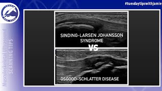 Differentiating SindingLarsen Johansson Syndrome and Osgood Schlatter Disease in the pediatric knee [upl. by Accem115]