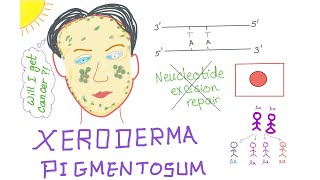 Xeroderma Pigmentosum [upl. by Ruscio]