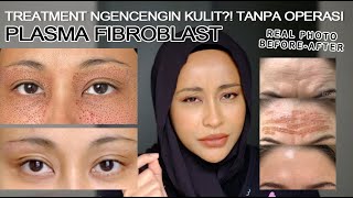 PLASMA FIBROBLAST NGENCENGIN KULIT WAJAH ALTERNATIF OPERASI [upl. by Arihday]