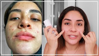 PRIMER MES CON TRATAMIENTO ANTI ACNÉ Con Epiduo Gel  Gabcamva [upl. by Aimik945]